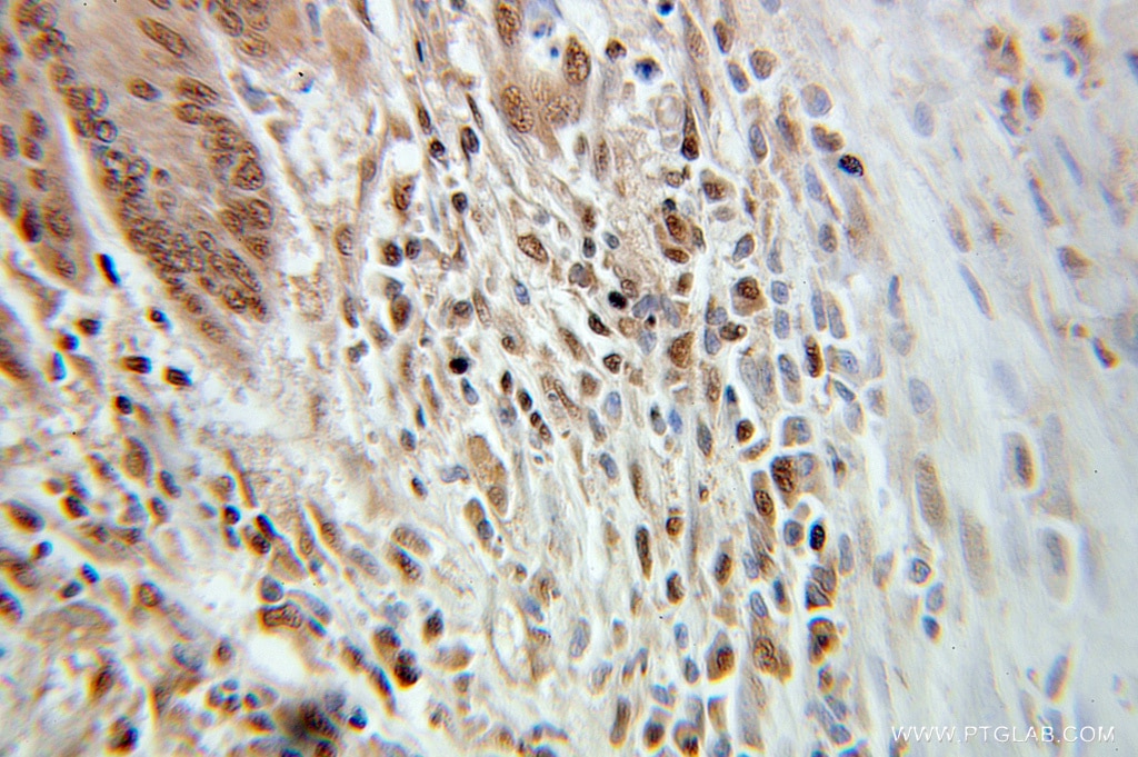 Immunohistochemistry of paraffin-embedded human colon cancer using 10690-1-AP(GMFB Antibody) at Dilution 1:100 (under 25x lens) GMFB IHC Immunohistochemical 10690-1-AP GMFB Antibody GMF