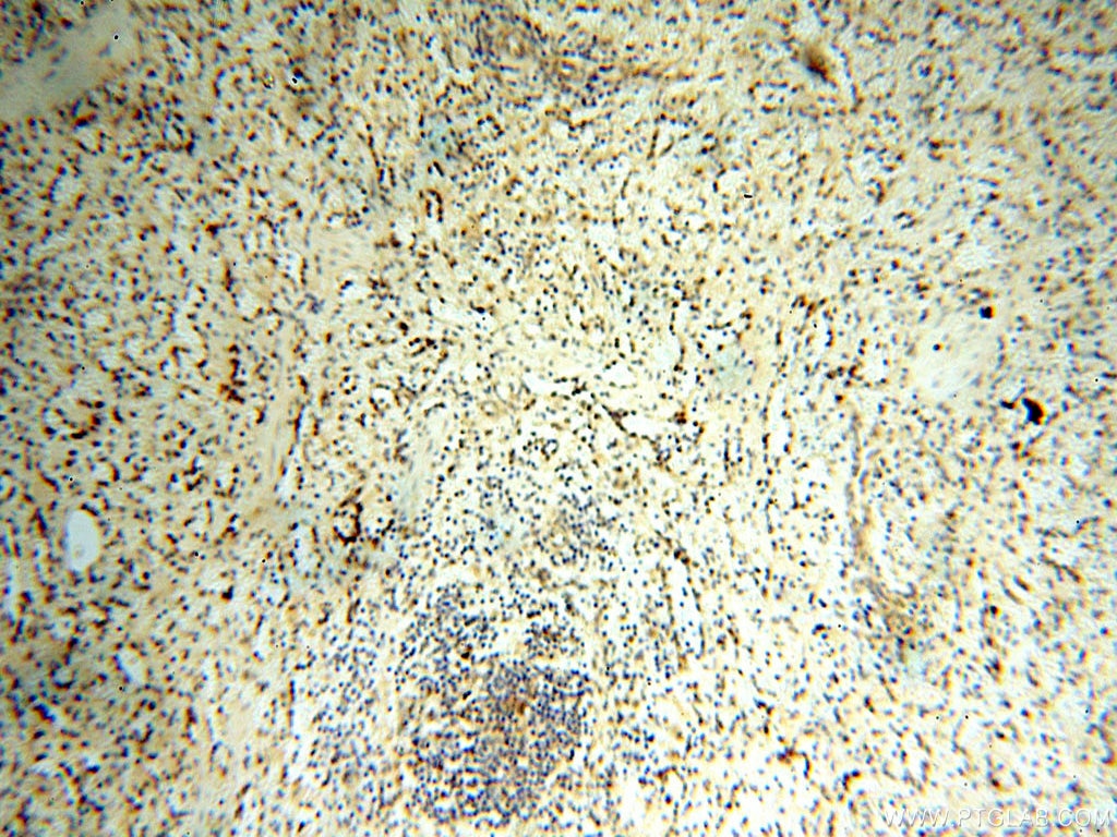 GOLM1 IHC Immunohistochemical 15126-1-AP GOLM1 Antibody C9orf155; FLJ22634; FLJ23608; GOLPH2; GP73; PSEC0257; bA379P1.3