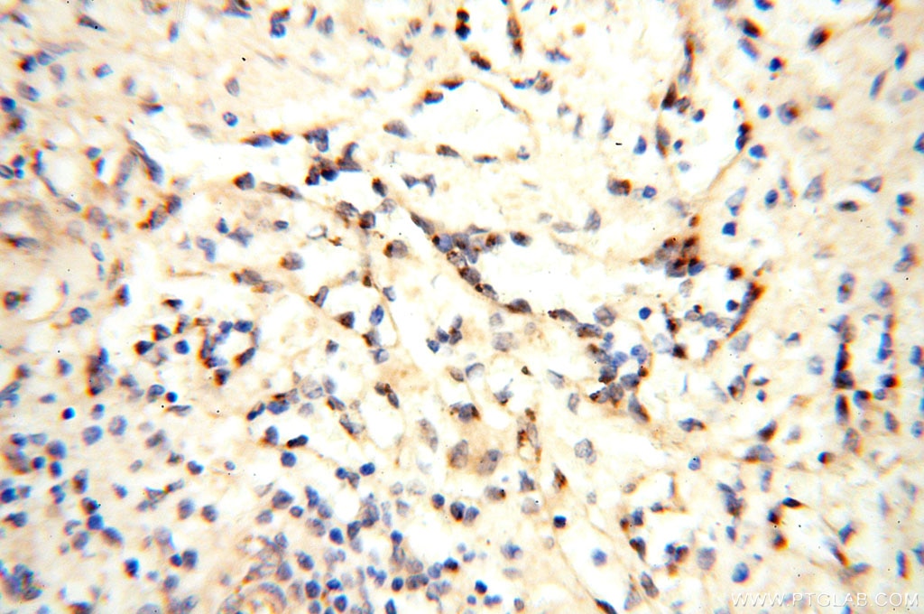 GOLM1 IHC Immunohistochemical 15126-1-AP GOLM1 Antibody C9orf155; FLJ22634; FLJ23608; GOLPH2; GP73; PSEC0257; bA379P1.3