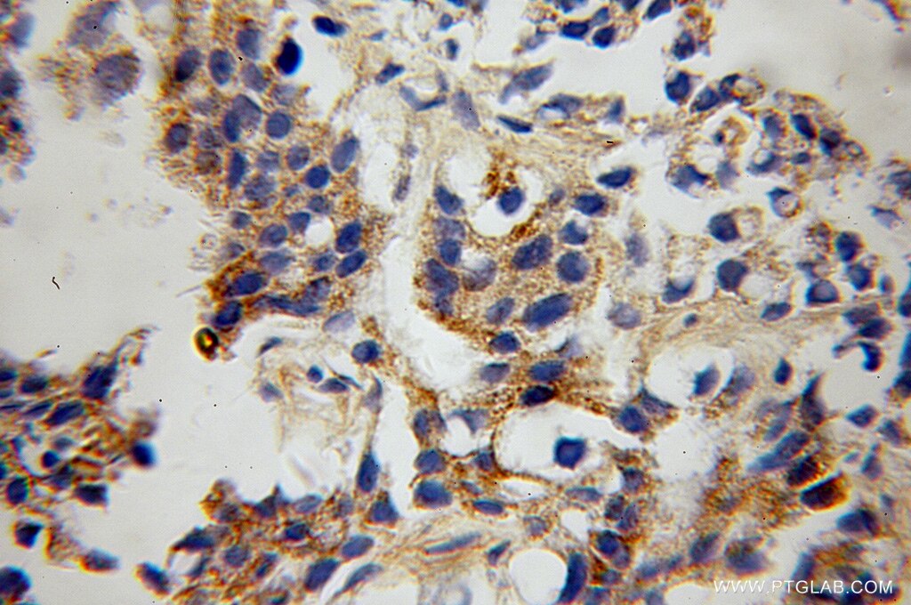 Immunohistochemistry of paraffin-embedded human gliomas using 13040-1-AP(GRID1 Antibody) at Dilution 1:100 (under 10x lens) GRID1 IHC Immunohistochemical 13040-1-AP GRID1 Antibody KIAA1220