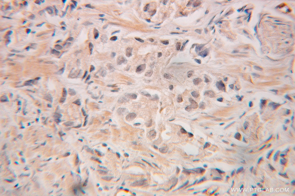 Immunohistochemistry of paraffin-embedded human prostate cancer using 10354-1-AP(GRWD1 Antibody) at Dilution 1:100 (under 25x lens) GRWD1 IHC Immunohistochemical 10354-1-AP GRWD1 Antibody GRWD; KIAA1942; RRB1; WDR28