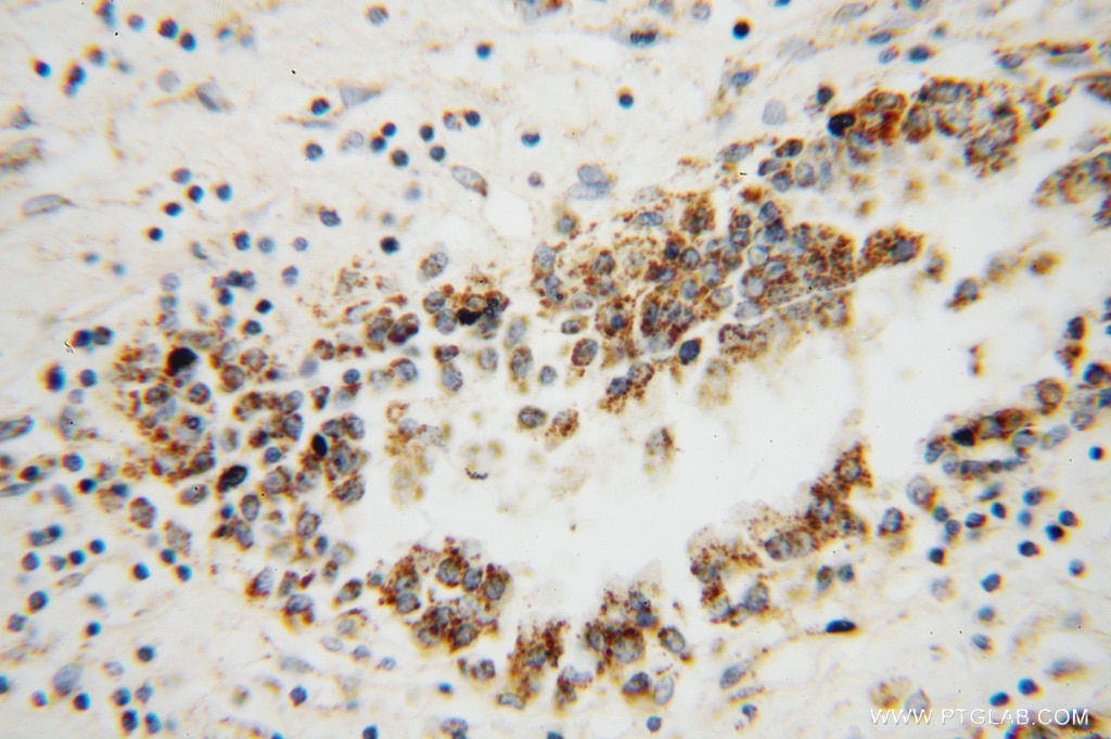 HSDL2 IHC Immunohistochemical 15631-1-AP HSDL2 Antibody C9orf99; FLJ25855; MGC10940; SDR13C1