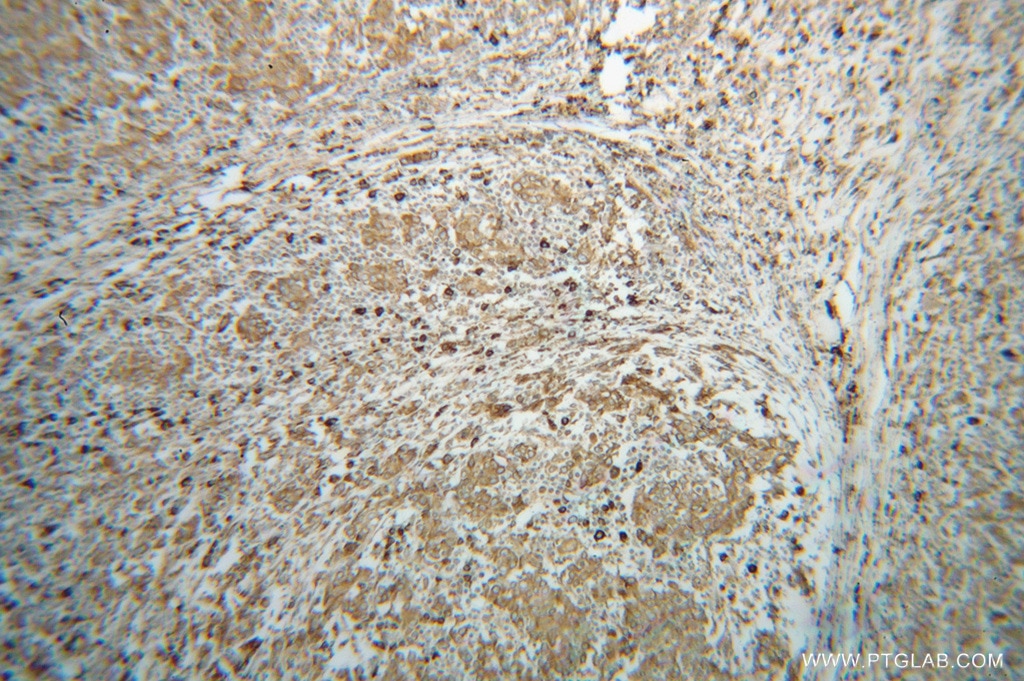 HSP90B1 IHC Immunohistochemical 14700-1-AP HSP90B1 Antibody ECGP; GP96; GRP94; TRA1