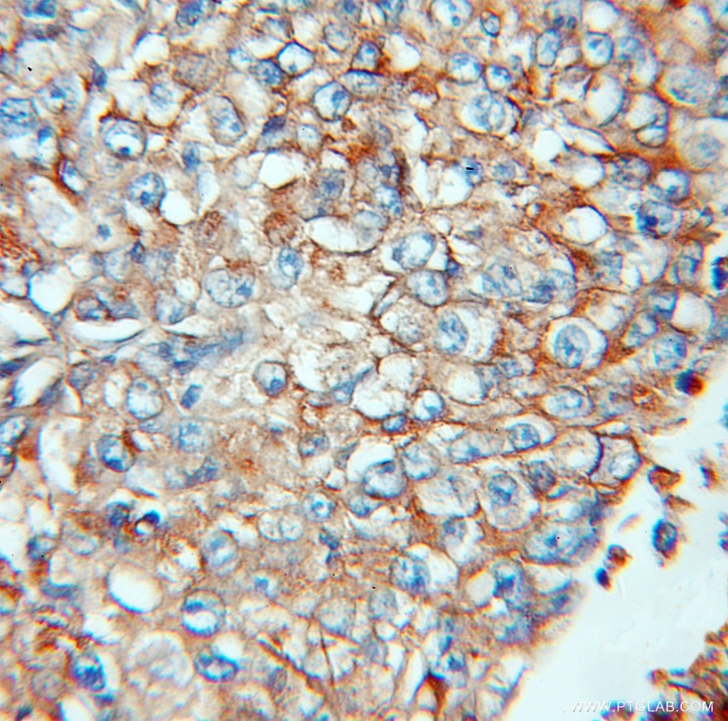 Immunohistochemistry of paraffin-embedded human lung cancer using 11714-1-AP(IFITM3 Antibody) at Dilution 1:100 (under 10x lens) IFITM3 IHC Immunohistochemical 11714-1-AP IFITM3 Antibody 1-8U; IP15