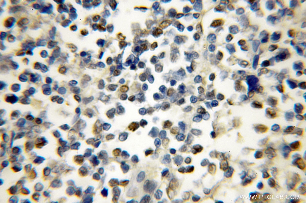 IKZF1 IHC Immunohistochemical 12016-1-AP IKZF1 Antibody Hs.54452; IK1; IKAROS; LYF1; PRO0758; ZNFN1A1; hIk-1