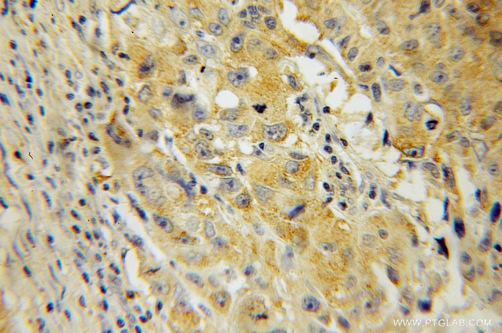 IMPDH2 IHC Immunohistochemical 12948-1-AP IMPDH2 Antibody IMPD2; IMPDH-II