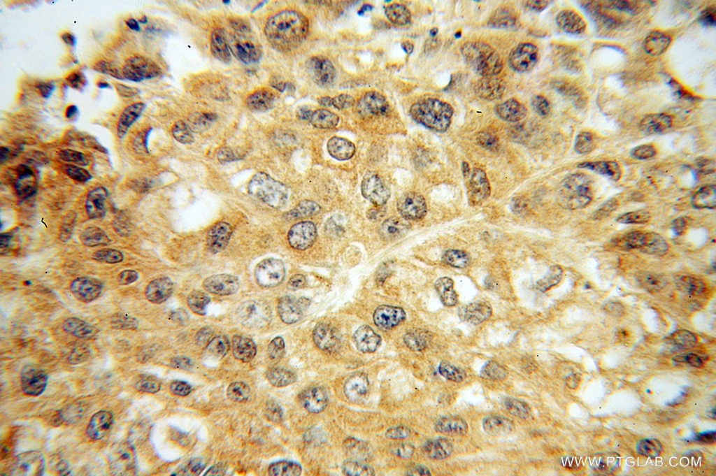 KEAP1 IHC Immunohistochemical 10503-2-AP KEAP1 Antibody INrf2; KIAA0132; KLHL19; MGC10630; MGC1114; MGC20887; MGC4407; MGC9454