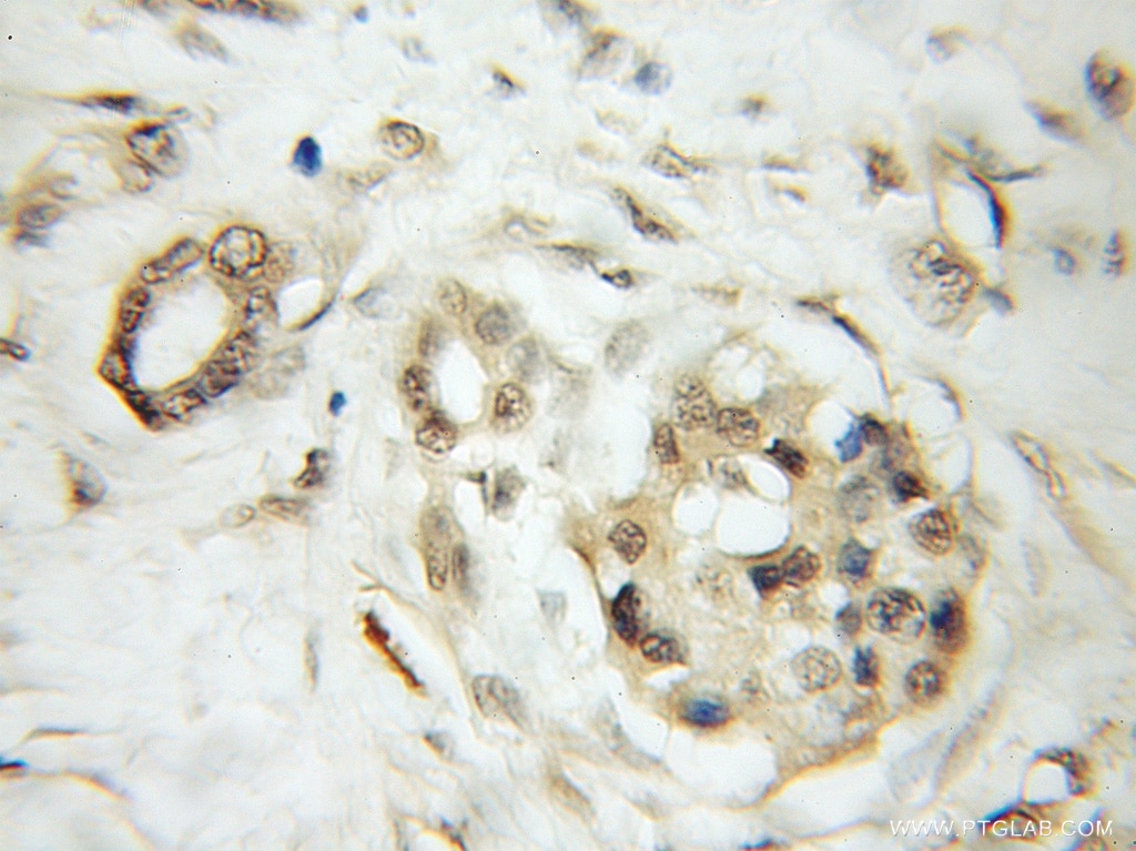 KIF12 IHC Immunohistochemical 12035-1-AP KIF12 Antibody RP11-56P10.3