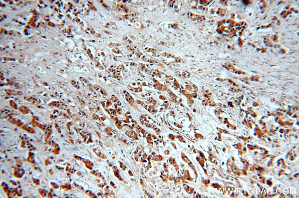Immunohistochemistry of paraffin-embedded human breast cancer using 18343-1-AP(KRT10 Antibody) at Dilution 1:50 (under 10x lens) KRT10 IHC Immunohistochemical 18343-1-AP KRT10 Antibody CK10; K10; KPP