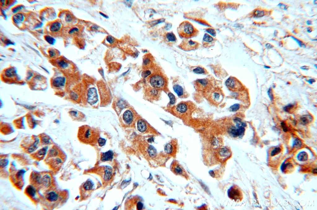 Immunohistochemistry of paraffin-embedded human breast cancer using 18343-1-AP(KRT10 Antibody) at Dilution 1:50 (under 40x lens) KRT10 IHC Immunohistochemical 18343-1-AP KRT10 Antibody CK10; K10; KPP
