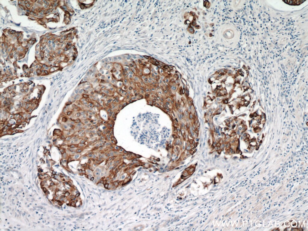 Immunohistochemistry of paraffin-embedded human cervical cancer using KRT14 Antibody 10143-1-AP (under 10x lens) KRT14 IHC Immunohistochemistry 10143-1-AP KRT14 Antibody CK14; EBS3; EBS4; K14; NFJ
