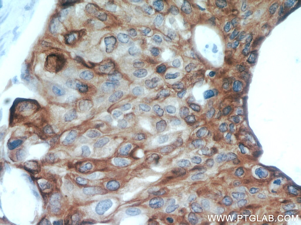 Immunohistochemistry of paraffin-embedded human cervical cancer using KRT14 Antibody 10143-1-AP (under 40x lens) KRT14 IHC Immunohistochemistry 10143-1-AP KRT14 Antibody CK14; EBS3; EBS4; K14; NFJ