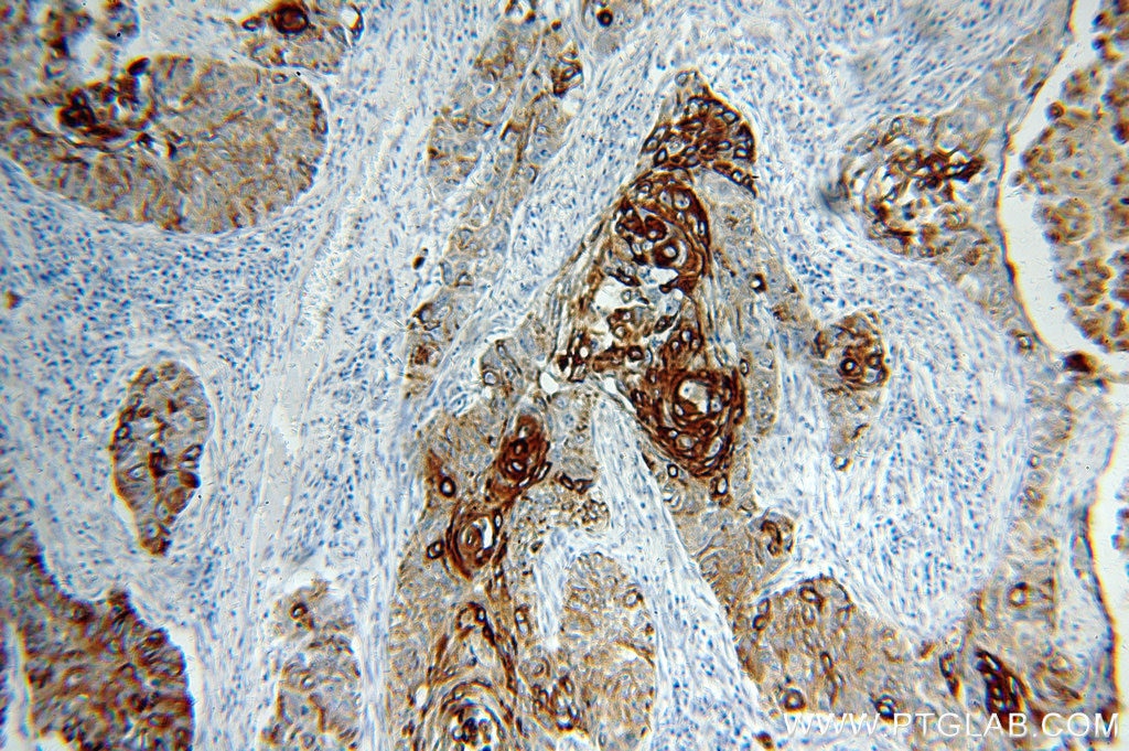 Immunohistochemistry of paraffin-embedded human lung cancer using KRT14 Antibody 10143-1-AP (under 10x lens) KRT14 IHC Immunohistochemistry 10143-1-AP KRT14 Antibody CK14; EBS3; EBS4; K14; NFJ