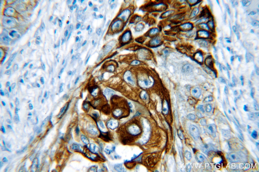 Immunohistochemistry of paraffin-embedded human lung cancer using KRT14 Antibody 10143-1-AP (under 40x lens) KRT14 IHC Immunohistochemistry 10143-1-AP KRT14 Antibody CK14; EBS3; EBS4; K14; NFJ