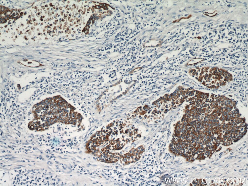Immunohistochemistry of paraffin-embedded human lung cancer using KRT14 Antibody 10143-1-AP (under 10x lens) KRT14 IHC Immunohistochemistry 10143-1-AP KRT14 Antibody CK14; EBS3; EBS4; K14; NFJ