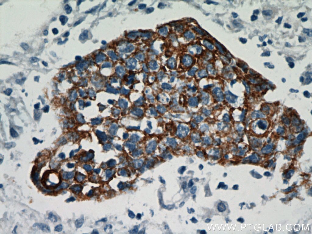 Immunohistochemistry of paraffin-embedded human lung cancer using KRT14 Antibody 10143-1-AP (under 40x lens) KRT14 IHC Immunohistochemistry 10143-1-AP KRT14 Antibody CK14; EBS3; EBS4; K14; NFJ