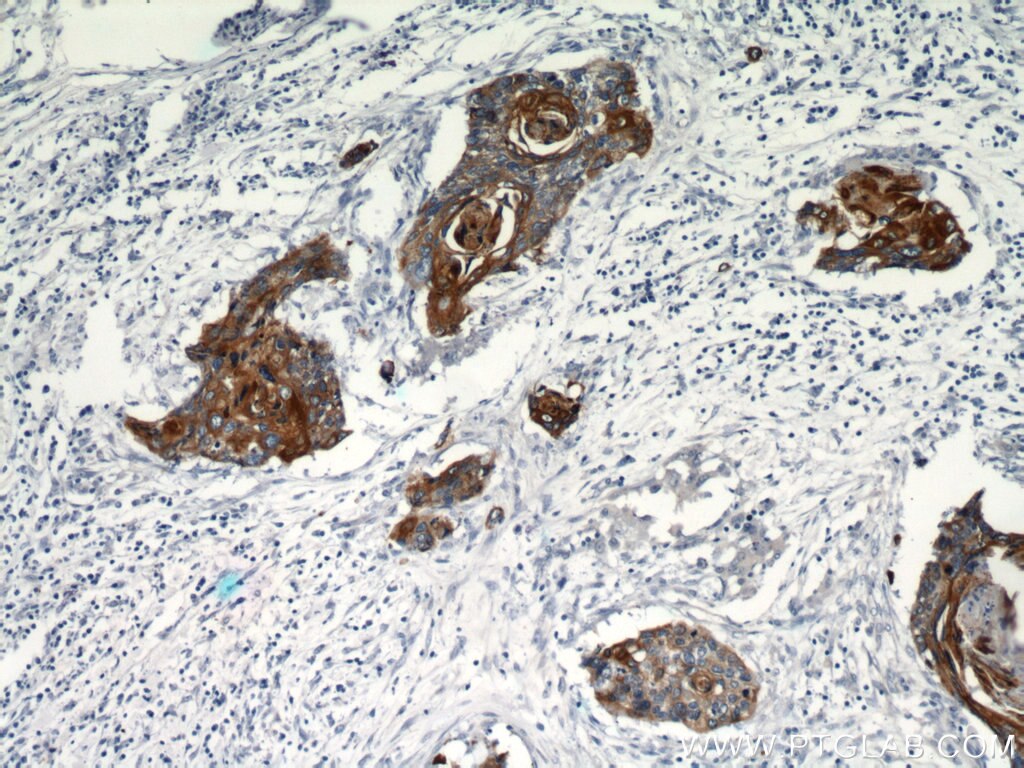Immunohistochemistry of paraffin-embedded human cervical cancer using KRT14 Antibody 10143-1-AP (under 10x lens) KRT14 IHC Immunohistochemistry 10143-1-AP KRT14 Antibody CK14; EBS3; EBS4; K14; NFJ