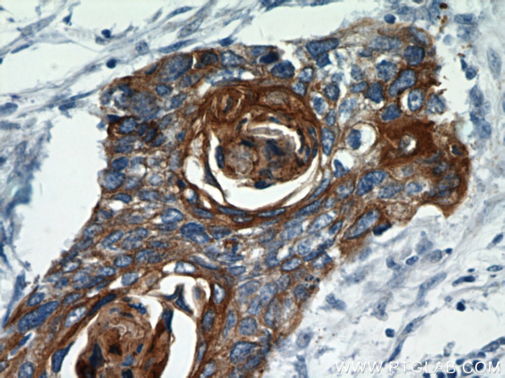 Immunohistochemistry of paraffin-embedded human cervical cancer using KRT14 Antibody 10143-1-AP (under 40x lens) KRT14 IHC Immunohistochemistry 10143-1-AP KRT14 Antibody CK14; EBS3; EBS4; K14; NFJ