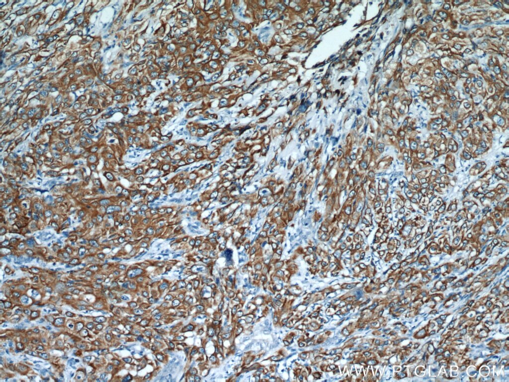 Immunohistochemistry of paraffin-embedded human cervical cancer using KRT14 Antibody 10143-1-AP (under 10x lens) KRT14 IHC Immunohistochemistry 10143-1-AP KRT14 Antibody CK14; EBS3; EBS4; K14; NFJ