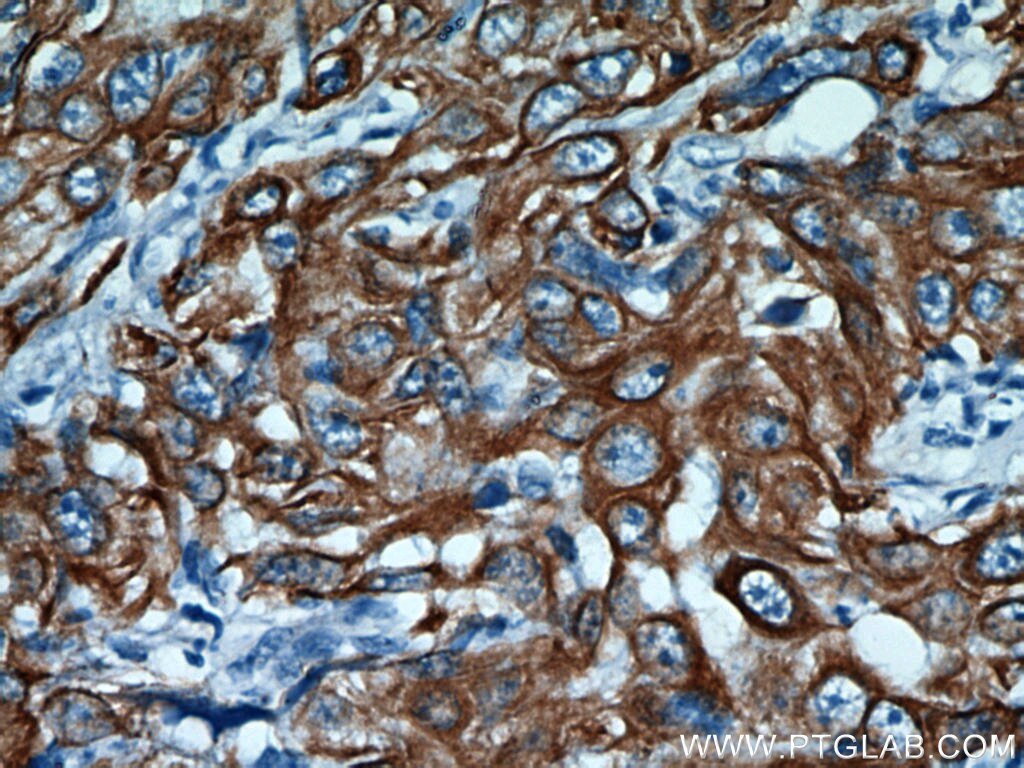 Immunohistochemistry of paraffin-embedded human cervical cancer using KRT14 Antibody 10143-1-AP (under 40x lens) KRT14 IHC Immunohistochemistry 10143-1-AP KRT14 Antibody CK14; EBS3; EBS4; K14; NFJ