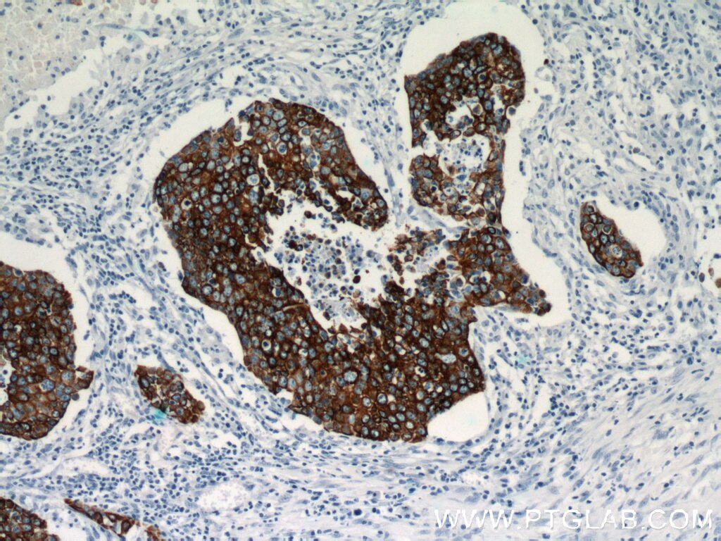 Immunohistochemistry of paraffin-embedded human lung cancer using KRT14 Antibody 10143-1-AP (under 10x lens) KRT14 IHC Immunohistochemistry 10143-1-AP KRT14 Antibody CK14; EBS3; EBS4; K14; NFJ