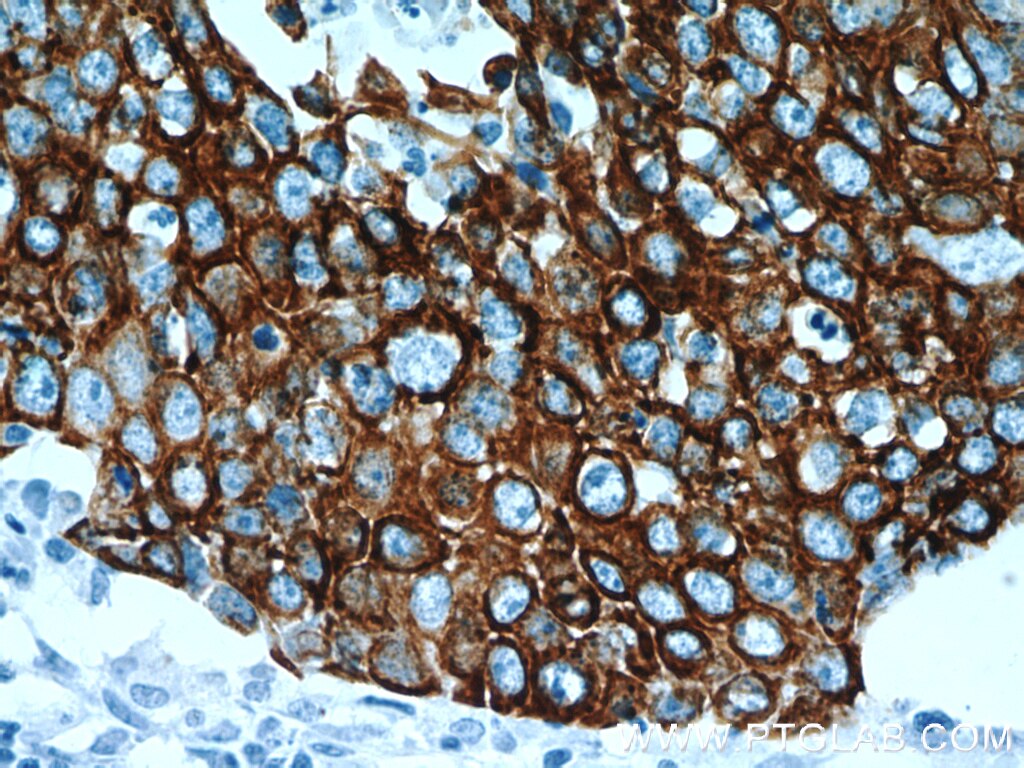 Immunohistochemistry of paraffin-embedded human lung cancer using KRT14 Antibody 10143-1-AP (under 40x lens) KRT14 IHC Immunohistochemistry 10143-1-AP KRT14 Antibody CK14; EBS3; EBS4; K14; NFJ