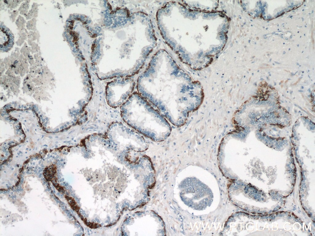 Immunohistochemistry of paraffin-embedded human prostate hyperplasia using KRT14 Antibody 10143-1-AP (under 10x lens) KRT14 IHC Immunohistochemistry 10143-1-AP KRT14 Antibody CK14; EBS3; EBS4; K14; NFJ