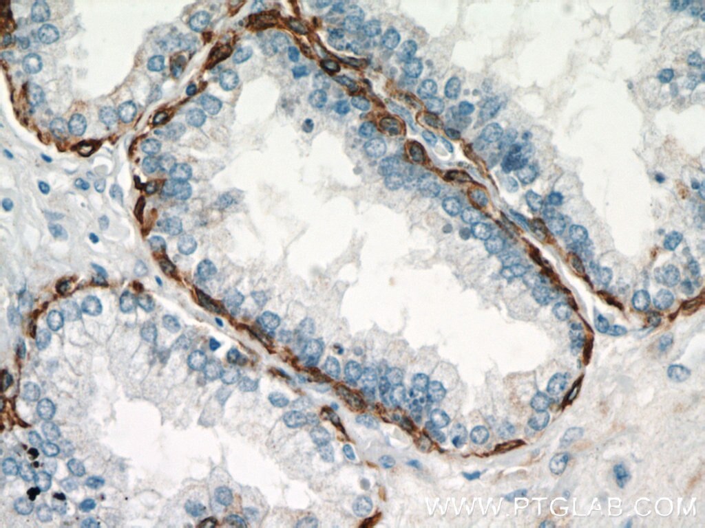 Immunohistochemistry of paraffin-embedded human prostate hyperplasia using KRT14 Antibody 10143-1-AP (under 40x lens) KRT14 IHC Immunohistochemistry 10143-1-AP KRT14 Antibody CK14; EBS3; EBS4; K14; NFJ