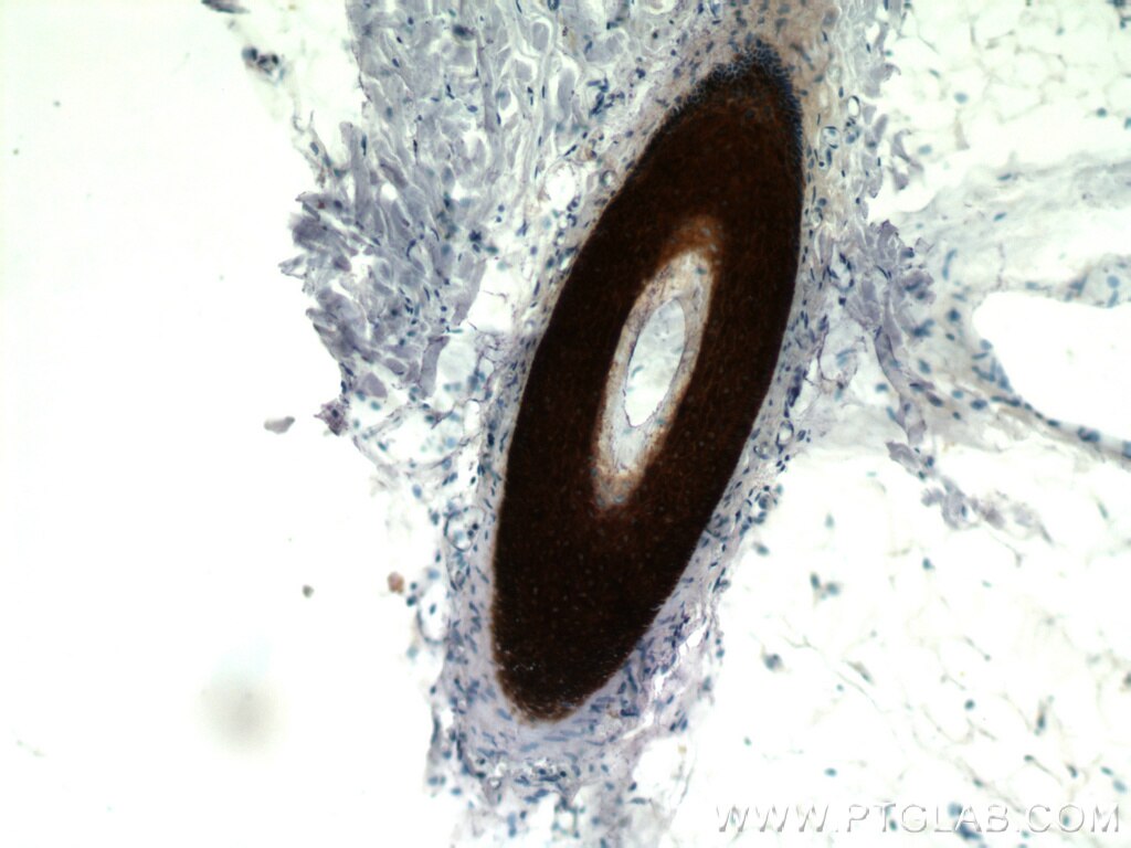 Immunohistochemistry of paraffin-embedded human skin using KRT14 Antibody 10143-1-AP (under 10x lens) KRT14 IHC Immunohistochemistry 10143-1-AP KRT14 Antibody CK14; EBS3; EBS4; K14; NFJ