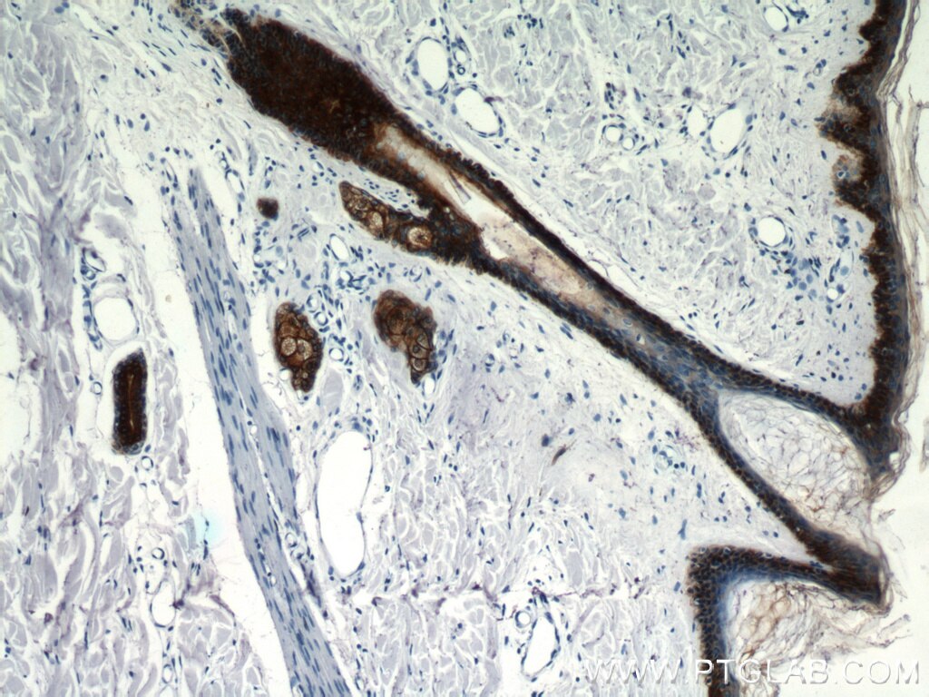 Immunohistochemistry of paraffin-embedded human skin using KRT14 Antibody 10143-1-AP (under 10x lens) KRT14 IHC Immunohistochemistry 10143-1-AP KRT14 Antibody CK14; EBS3; EBS4; K14; NFJ