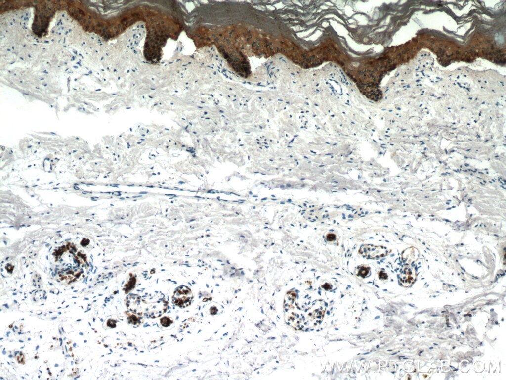 Immunohistochemistry of paraffin-embedded human skin using KRT14 Antibody 10143-1-AP (under 10x lens) KRT14 IHC Immunohistochemistry 10143-1-AP KRT14 Antibody CK14; EBS3; EBS4; K14; NFJ