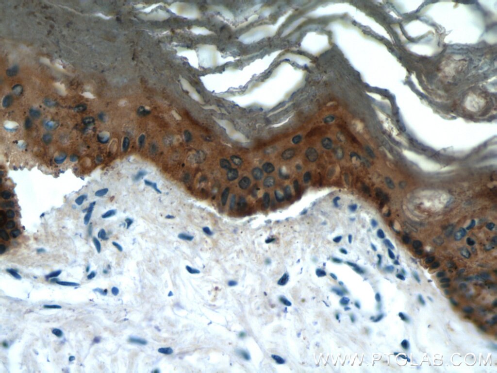 Immunohistochemistry of paraffin-embedded human skin using KRT14 Antibody 10143-1-AP (under 40x lens) KRT14 IHC Immunohistochemistry 10143-1-AP KRT14 Antibody CK14; EBS3; EBS4; K14; NFJ