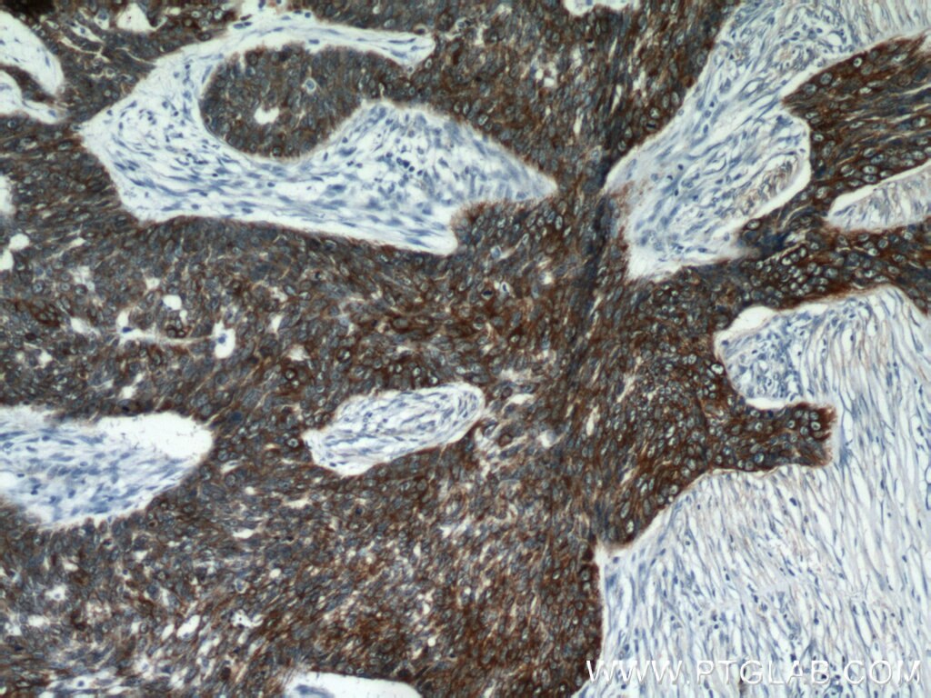 Immunohistochemistry of paraffin-embedded human skin cancer using KRT14 Antibody 10143-1-AP (under 10x lens) KRT14 IHC Immunohistochemistry 10143-1-AP KRT14 Antibody CK14; EBS3; EBS4; K14; NFJ