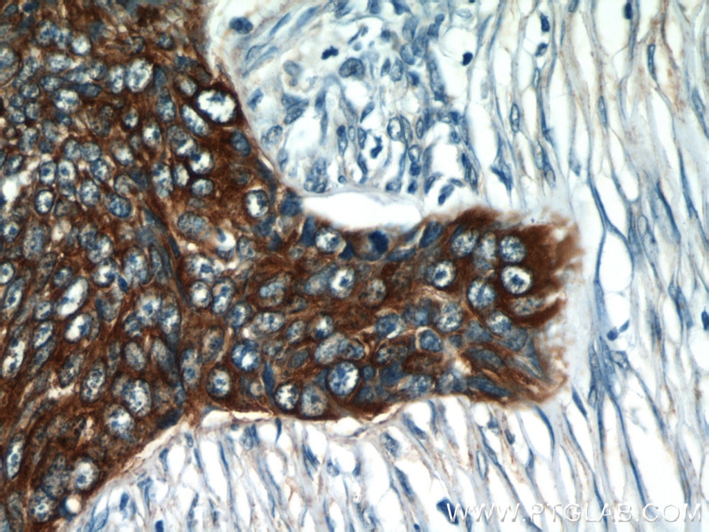 Immunohistochemistry of paraffin-embedded human skin cancer using KRT14 Antibody 10143-1-AP (under 40x lens) KRT14 IHC Immunohistochemistry 10143-1-AP KRT14 Antibody CK14; EBS3; EBS4; K14; NFJ
