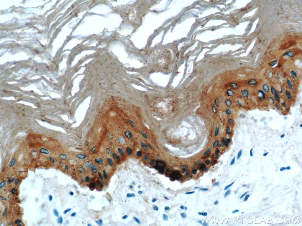 Immunohistochemistry of paraffin-embedded human skin using KRT14 Antibody 10143-1-AP (under 40x lens) KRT14 IHC Immunohistochemistry 10143-1-AP KRT14 Antibody CK14; EBS3; EBS4; K14; NFJ