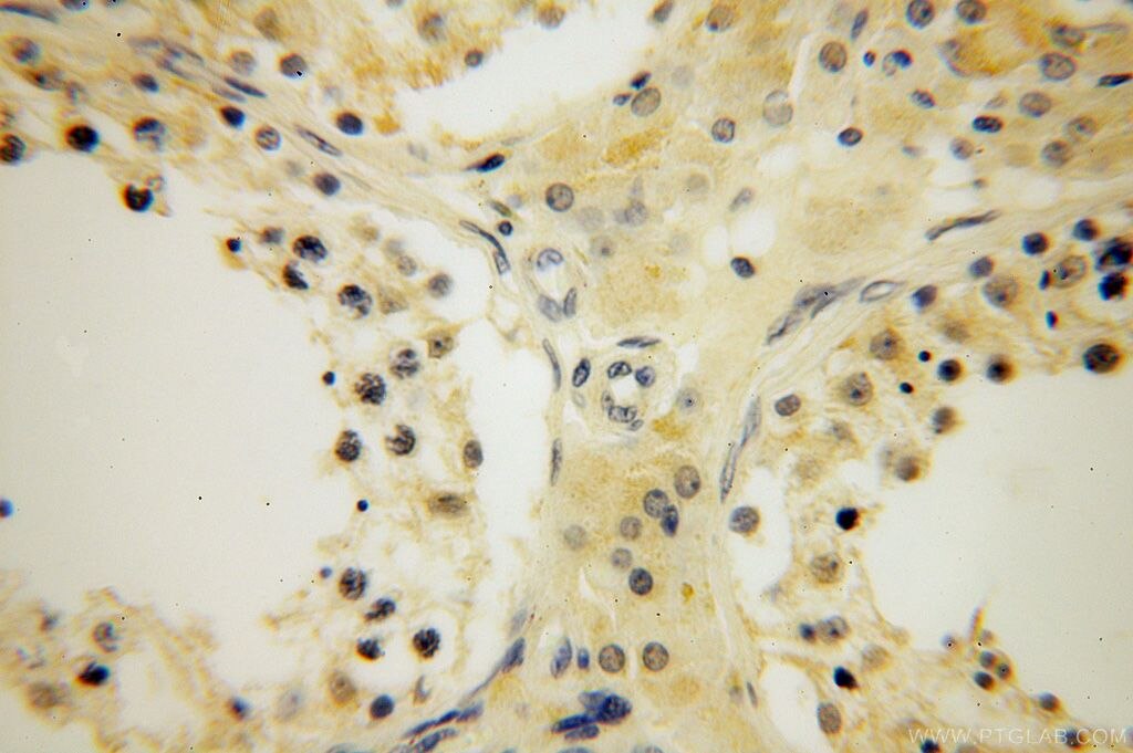 Immunohistochemistry of paraffin-embedded human testis using KRT14 Antibody 10143-1-AP (under 40x lens) KRT14 IHC Immunohistochemistry 10143-1-AP KRT14 Antibody CK14; EBS3; EBS4; K14; NFJ