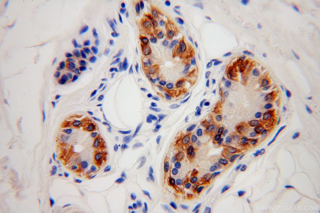 Immunohistochemistry of paraffin-embedded human skin using KRT14 Antibody 10143-1-AP (under 40x lens) KRT14 IHC Immunohistochemistry 10143-1-AP KRT14 Antibody CK14; EBS3; EBS4; K14; NFJ