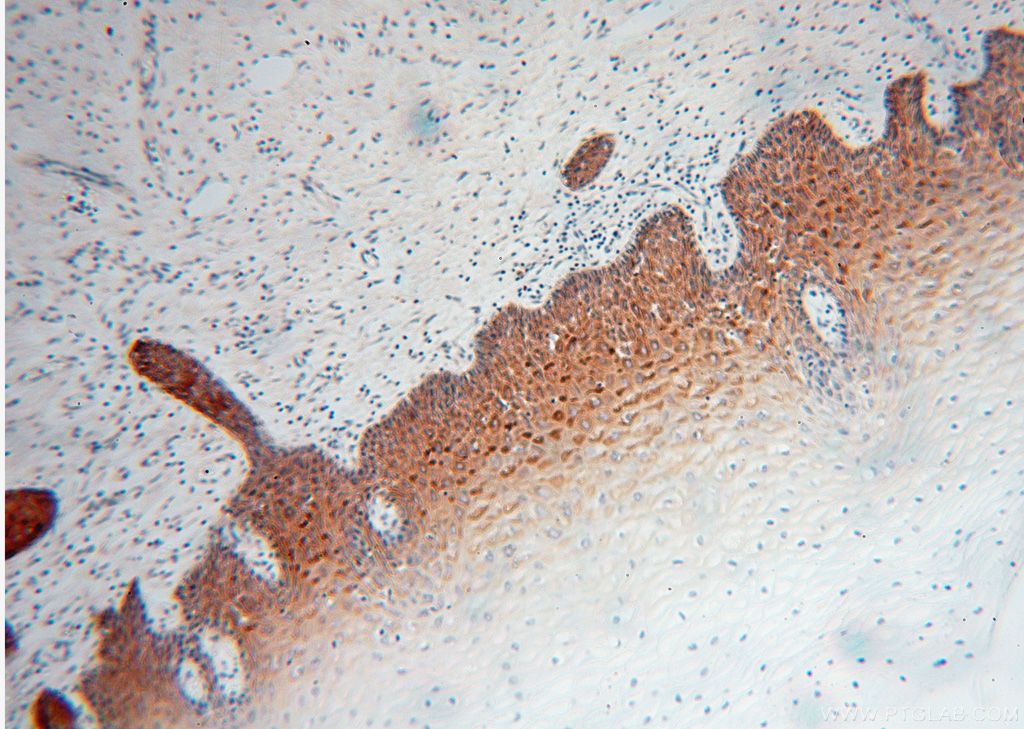 KRT14 IHC Immunohistochemical 10143-1-AP KRT14 Antibody CK14; EBS3; EBS4; K14; NFJ