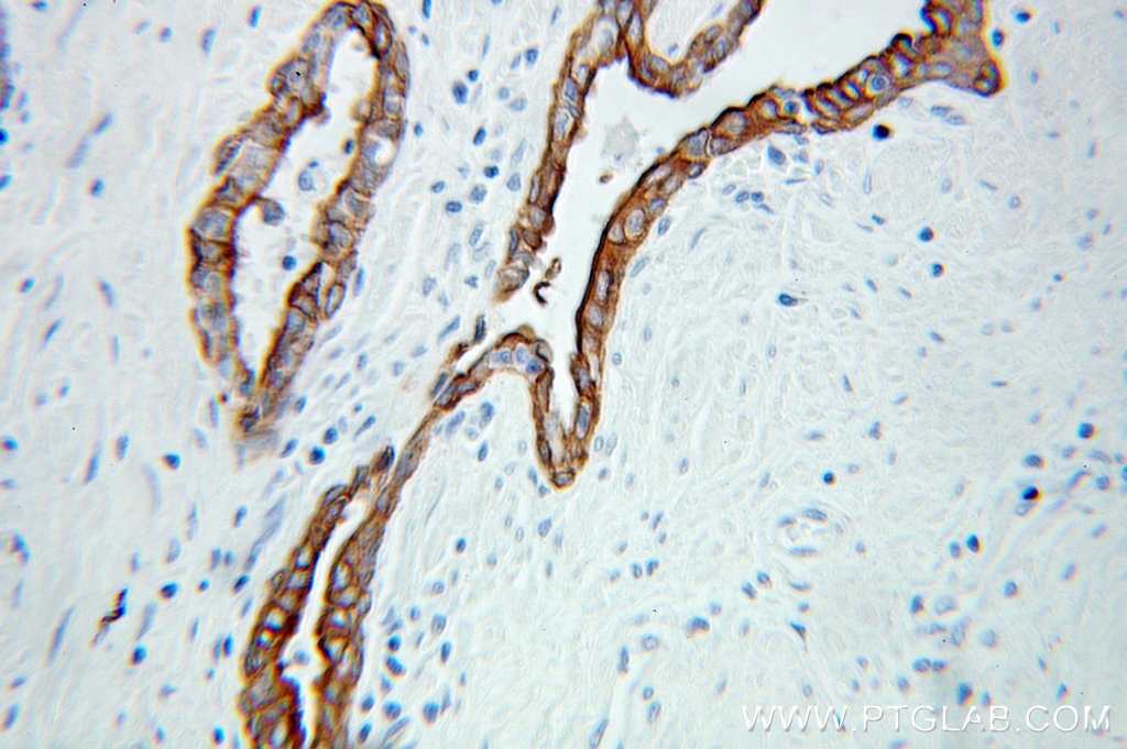 KRT19 IHC Immunohistochemical 10712-1-AP KRT19 Antibody CK19; K19; K1CS; MGC15366