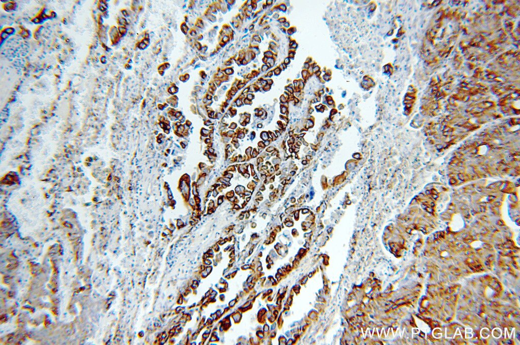 KRT19-specific IHC Immunohistochemical 16858-1-AP KRT19-specific Antibody CK19; K19; K1CS; MGC15366