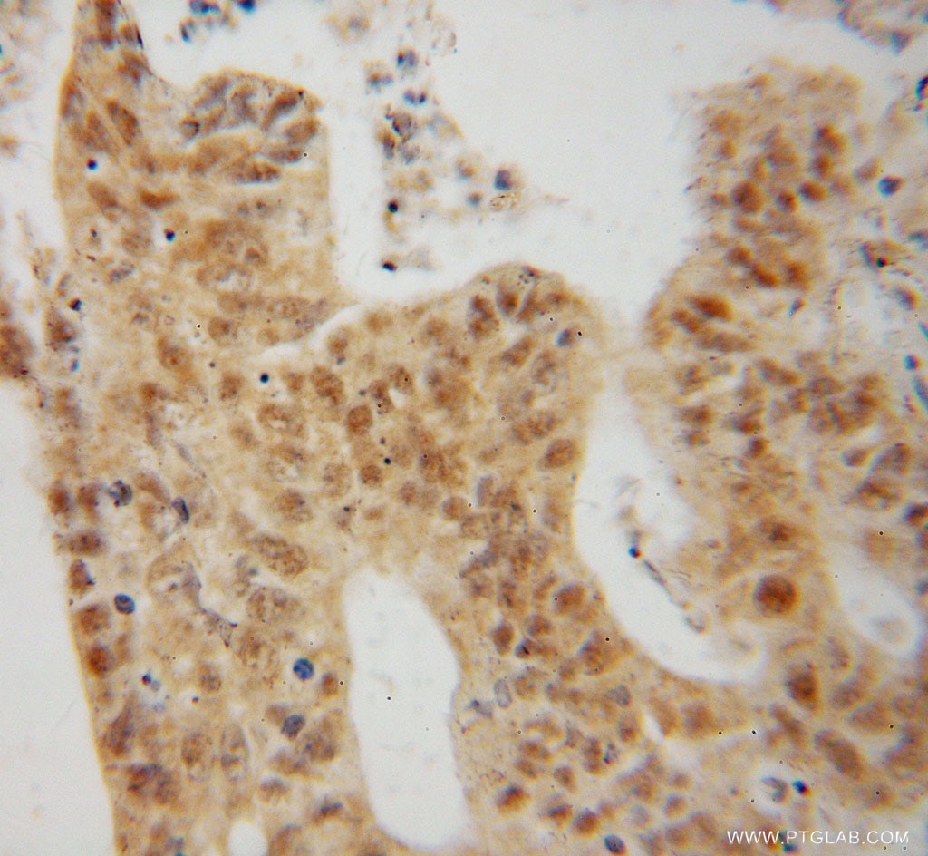 MAP1S IHC Immunohistochemical 15695-1-AP MAP1S Antibody BPY2IP1; C19orf5; FLJ10669; MAP8; MGC133087; VCY2IP-1; VCY2IP1