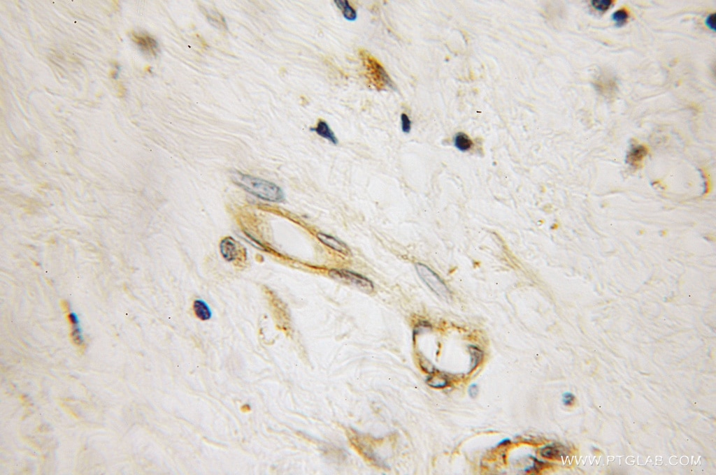 Immunohistochemistry of paraffin-embedded human breast cancer using 12745-1-AP(MAP2K6 Antibody) at Dilution 1:100 (under 10x lens) MAP2K6 IHC Immunohistochemical 12745-1-AP MAP2K6 Antibody MAPKK6; MEK6; MKK6; PRKMK6; SAPKK3