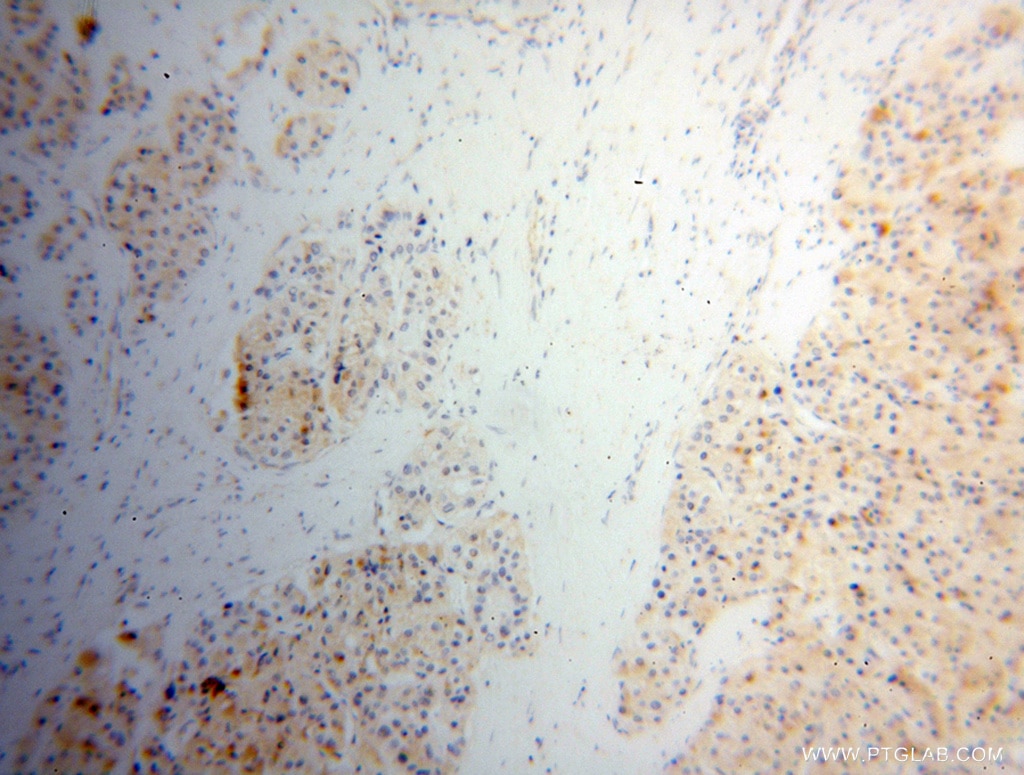 Immunohistochemistry of paraffin-embedded human liver cancer using 14986-1-AP(MGLL Antibody) at Dilution 1:100 (under 10x lens) MGLL IHC Immunohistochemical 14986-1-AP MGLL Antibody HU-K5; HUK5; MGL
