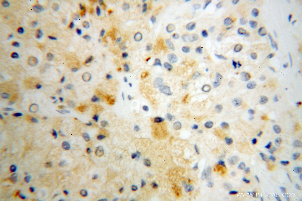 Immunohistochemistry of paraffin-embedded human liver cancer using 14986-1-AP(MGLL Antibody) at Dilution 1:100 (under 40x lens) MGLL IHC Immunohistochemical 14986-1-AP MGLL Antibody HU-K5; HUK5; MGL