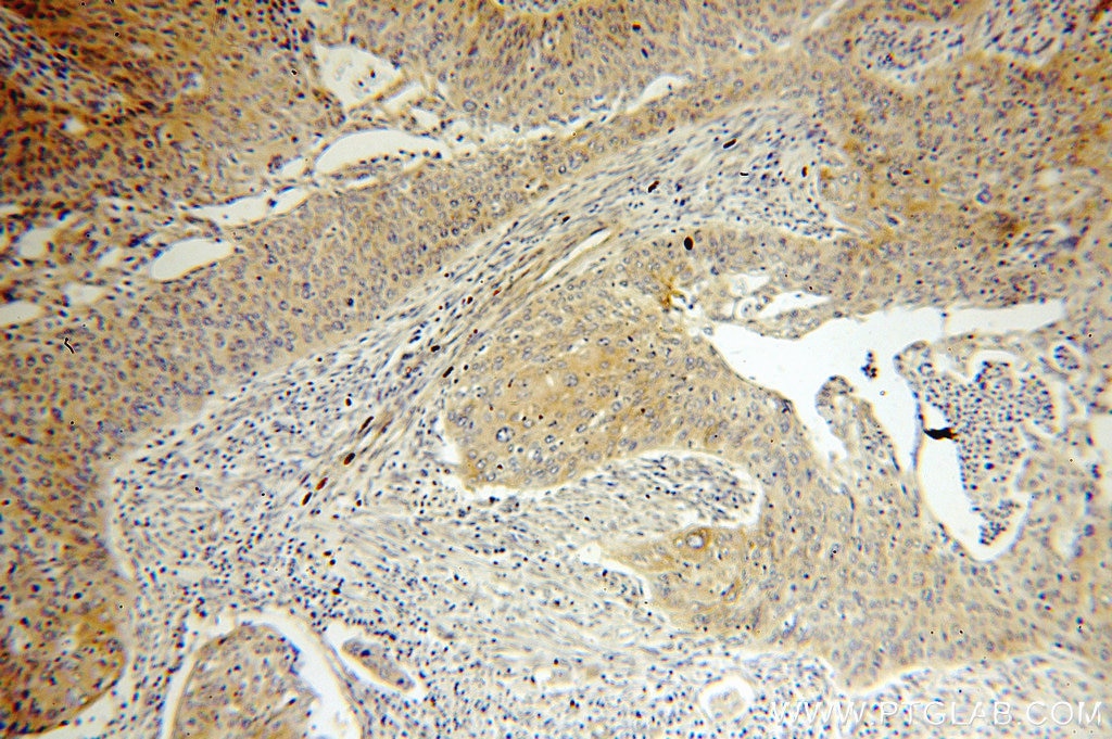 MMP1 IHC Immunohistochemical 10371-2-AP MMP1 Antibody MMP1;CLG;CLGN ;