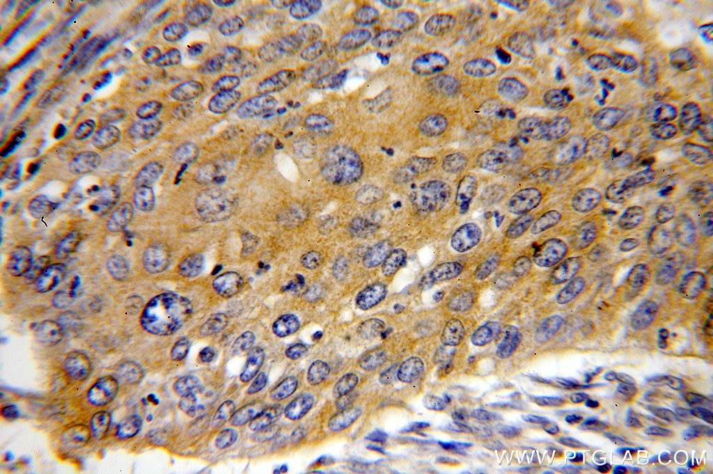 MMP1 IHC Immunohistochemical 10371-2-AP MMP1 Antibody MMP1;CLG;CLGN ;