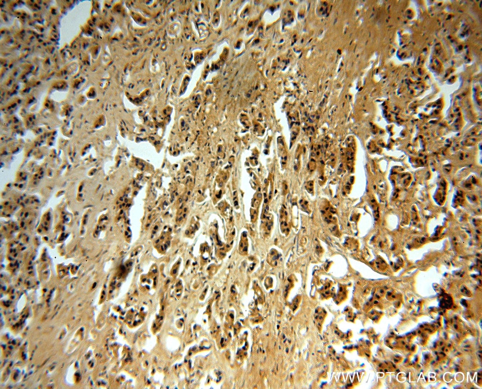 MMP13 IHC Immunohistochemical 18165-1-AP MMP13 Antibody CLG3