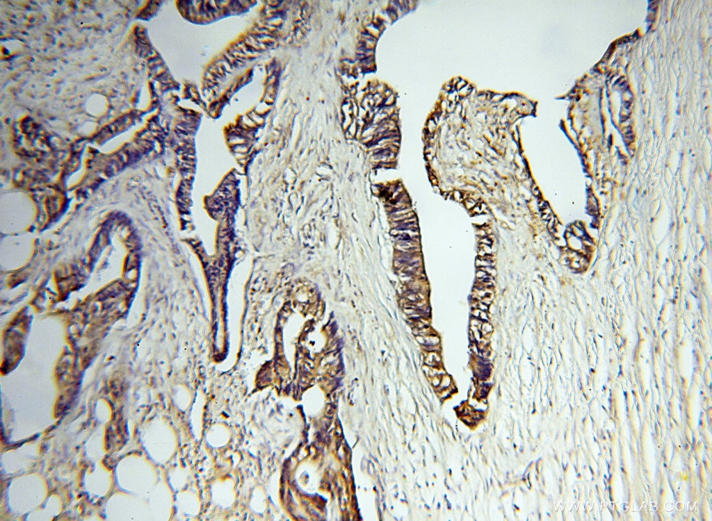 MMP3 IHC Immunohistochemical 17873-1-AP MMP3 Antibody CHDS6; MGC126102; MGC126103; MGC126104; MMP-3; SL-1; STMY; STMY1; STR1