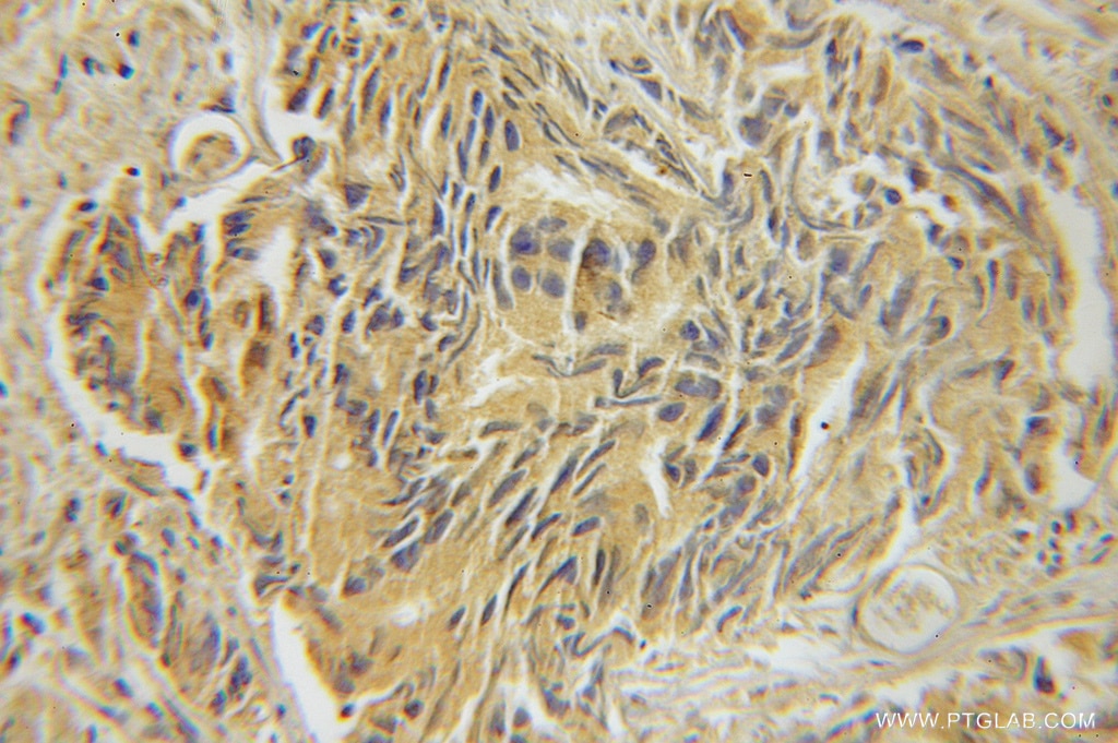 Immunohistochemistry of paraffin-embedded human prostate cancer using 10004-2-Ig(Marcks Antibody) at Dilution 1:200 (under 10x lens) Marcks IHC Immunohistochemical 10004-2-Ig Marcks Antibody Macs; PKCSL