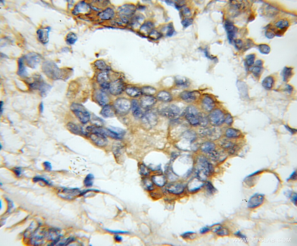Immunohistochemistry of paraffin-embedded human breast cancer using 11410-1-AP(NAT2 Antibody) at Dilution 1:50 (under 10x lens) NAT2 IHC Immunohistochemical 11410-1-AP NAT2 Antibody AAC2; PNAT
